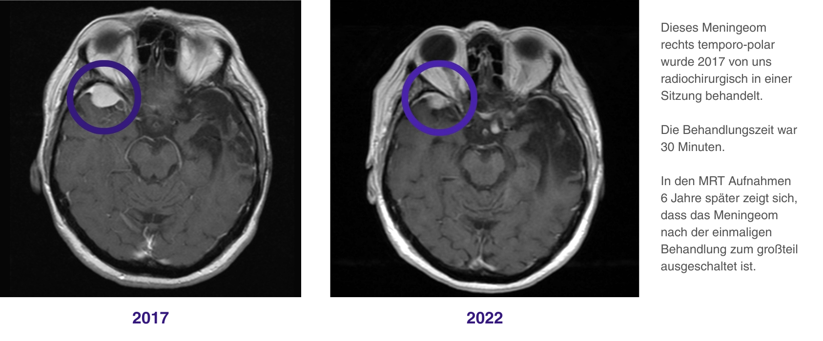 Radiochirurgsche Behandlung eines Meningeoms