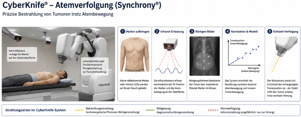 Synchrony System Cyberknife Atemverfolgung
